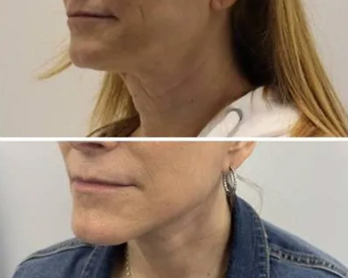 Deep Plane Facelift Before & After Gallery - Patient 699264 - Image 4
