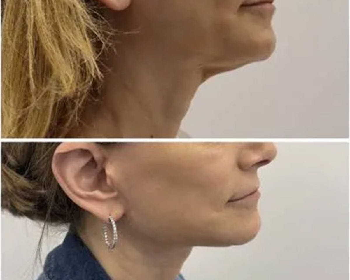 Deep Plane Facelift Before & After Gallery - Patient 699264 - Image 5