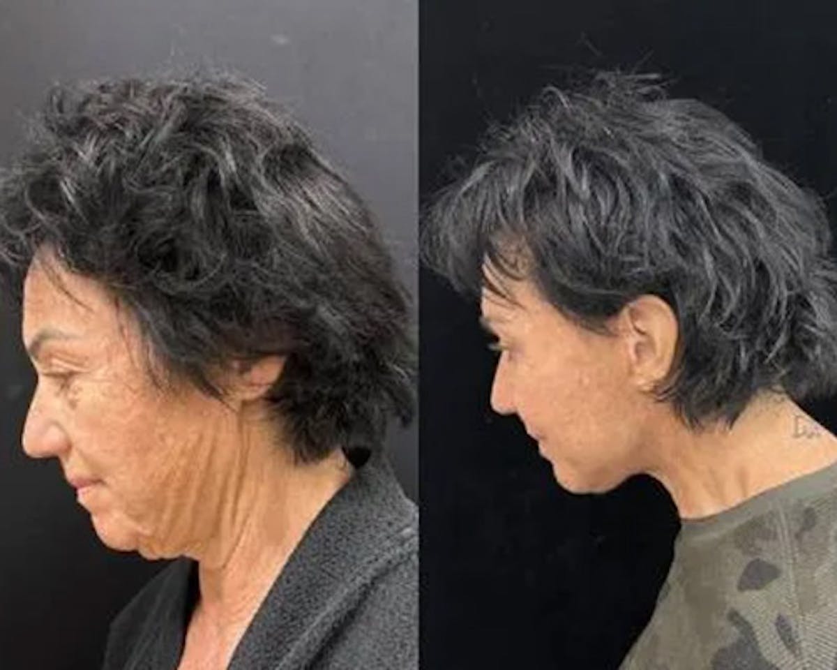 Deep Plane Facelift Before & After Gallery - Patient 423377 - Image 1