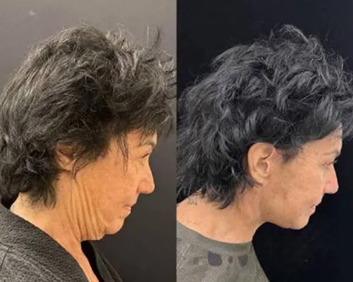 Deep Plane Facelift Before & After Gallery - Patient 423377 - Image 2