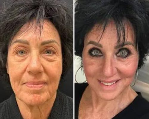 Deep Plane Facelift Before & After Gallery - Patient 423377 - Image 3