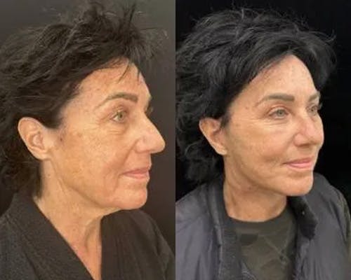 Deep Plane Facelift Before & After Gallery - Patient 423377 - Image 4