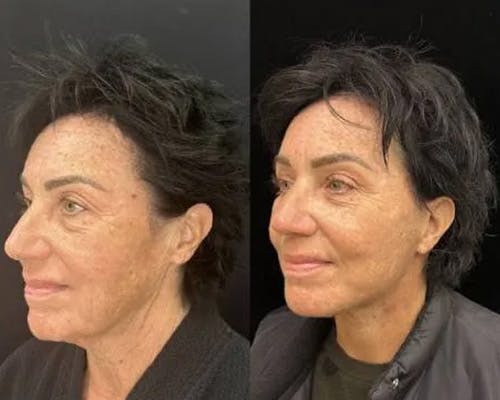 Deep Plane Facelift Before & After Gallery - Patient 423377 - Image 5