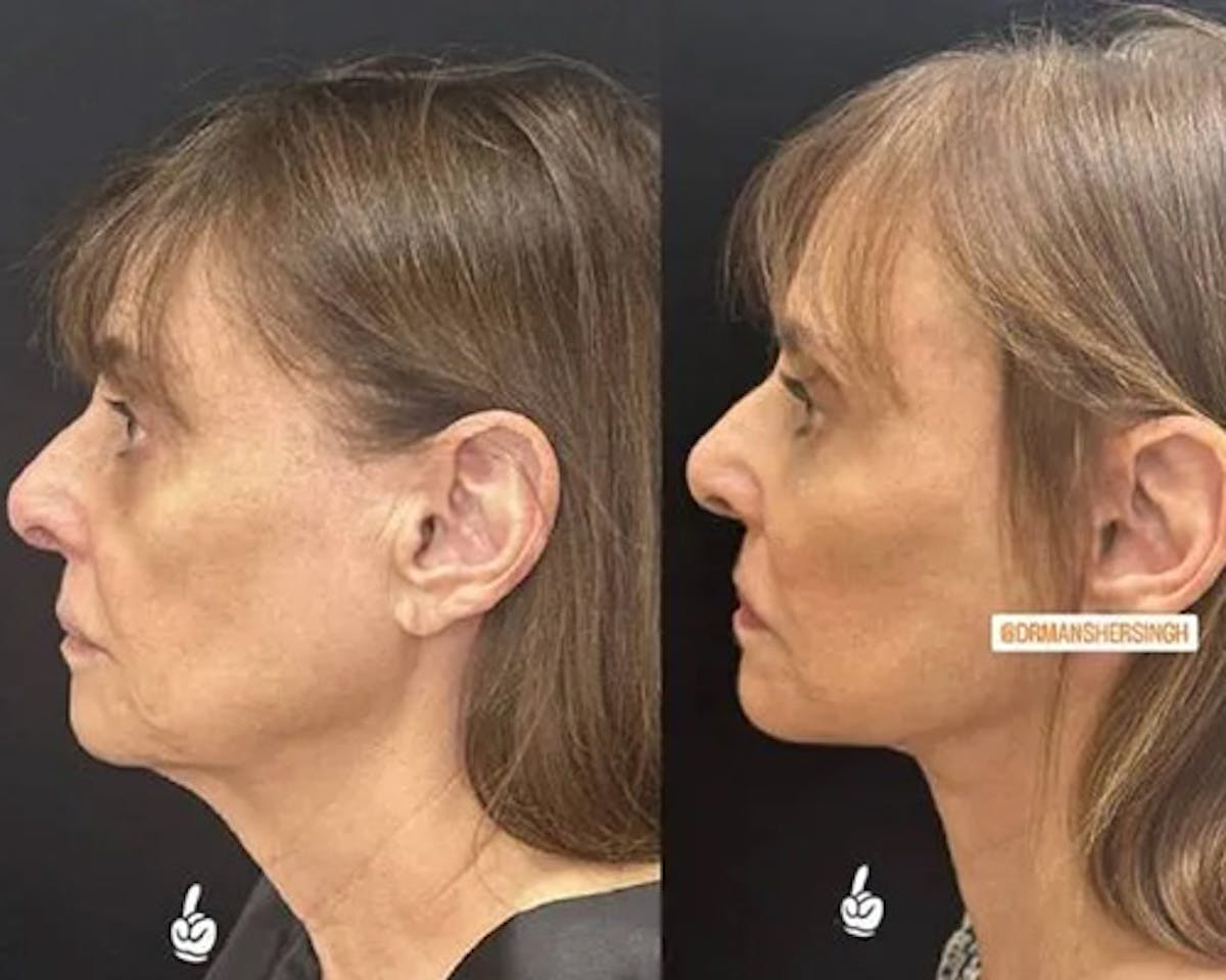 Deep Plane Facelift Before & After Gallery - Patient 341020 - Image 1