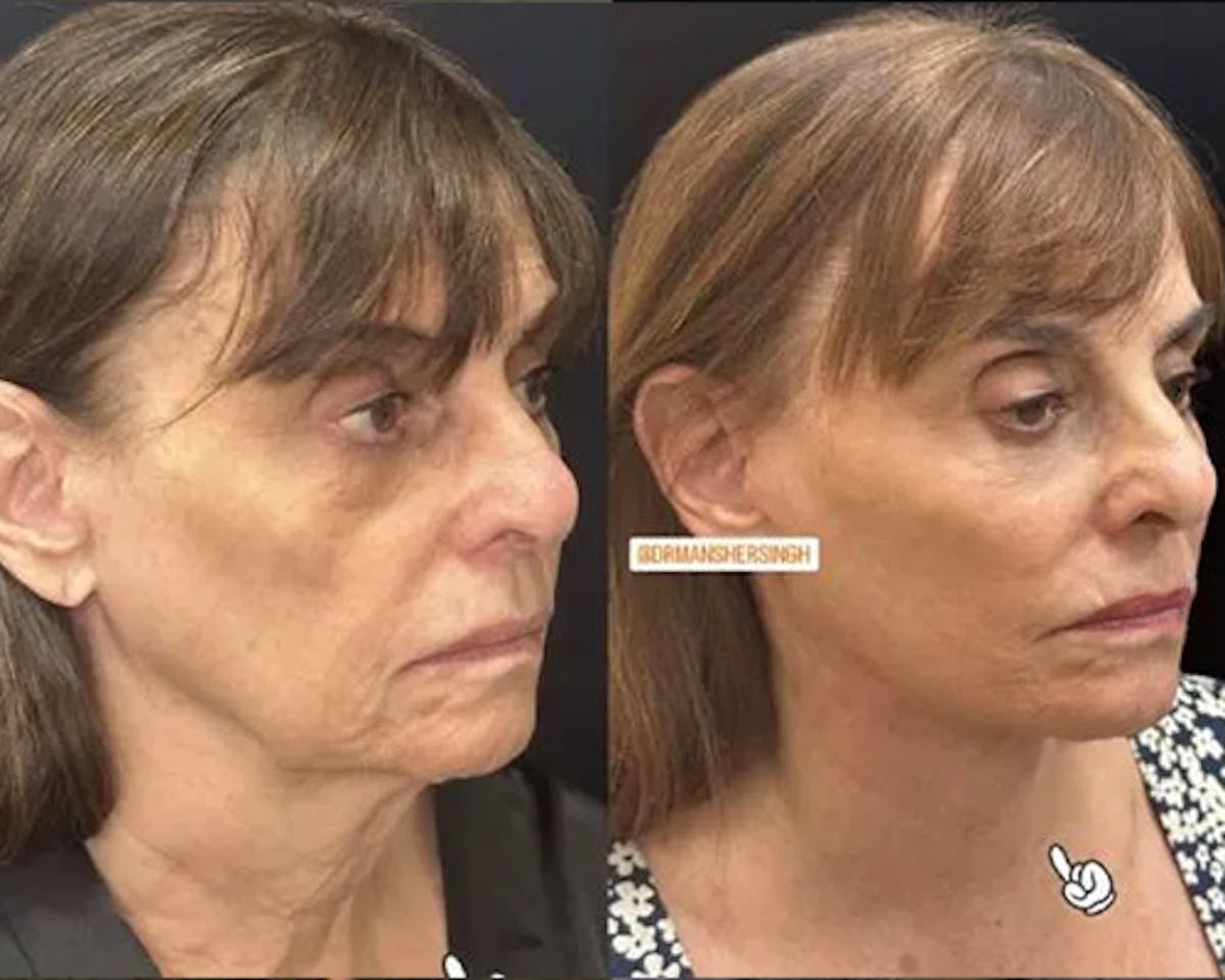 Deep Plane Facelift Before & After Gallery - Patient 341020 - Image 2