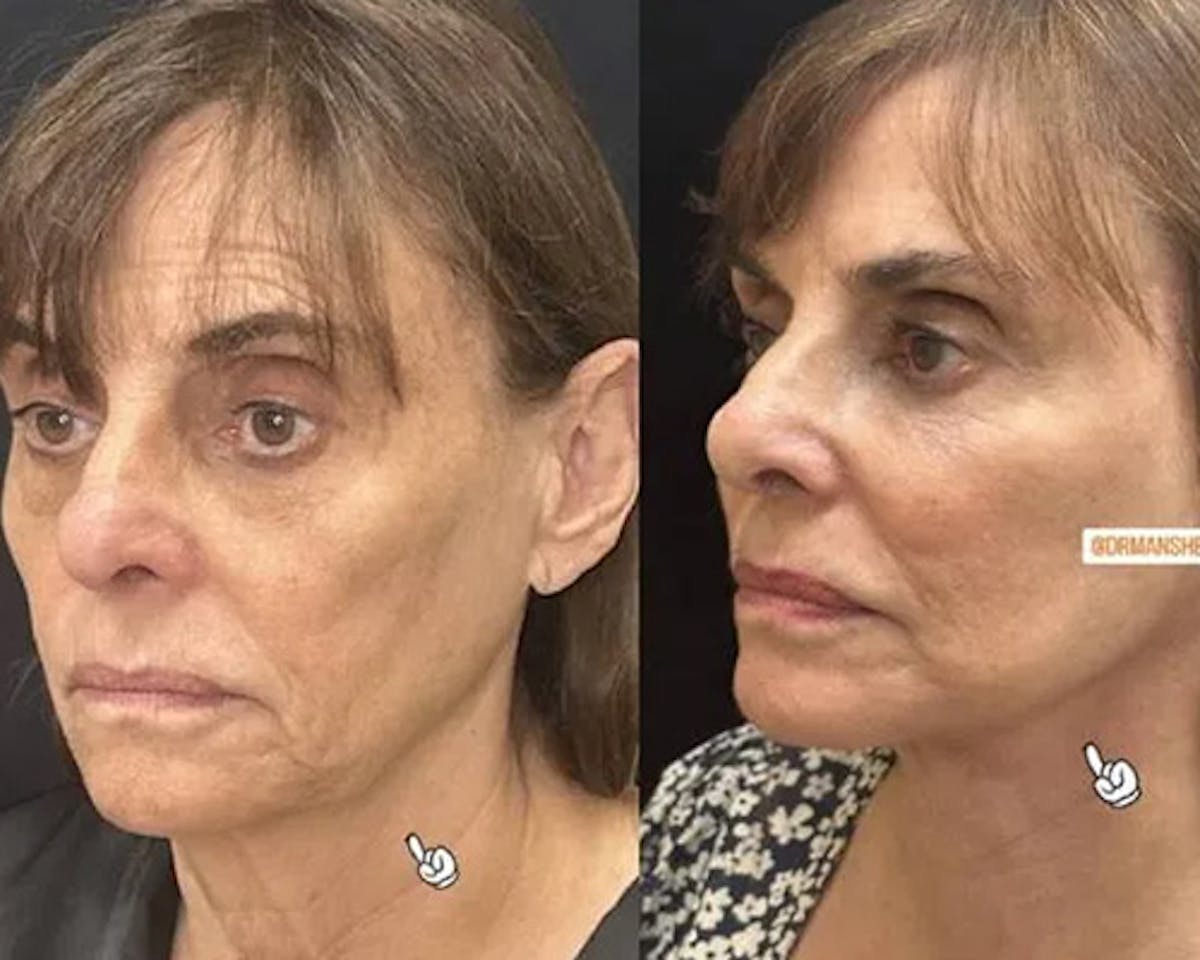Deep Plane Facelift Before & After Gallery - Patient 341020 - Image 3