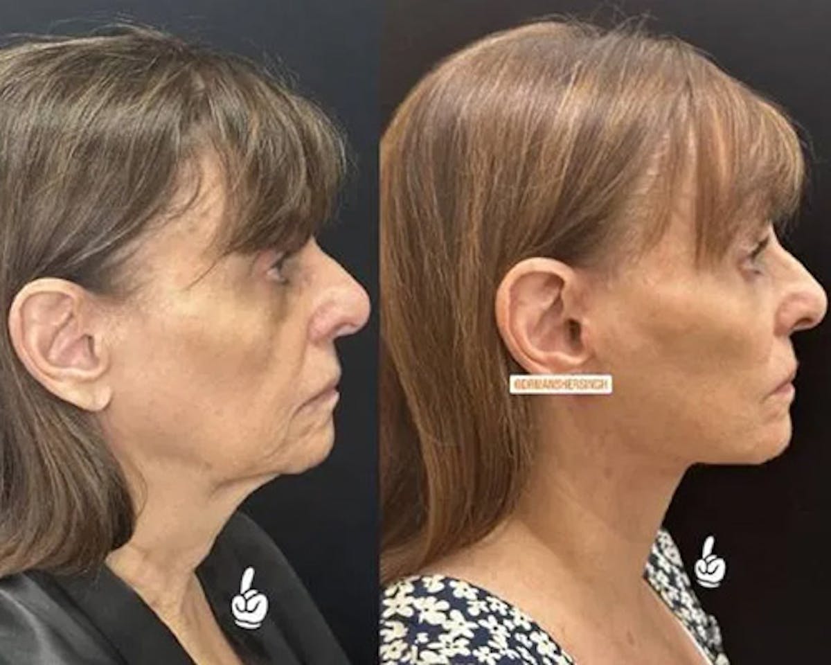 Deep Plane Facelift Before & After Gallery - Patient 341020 - Image 4