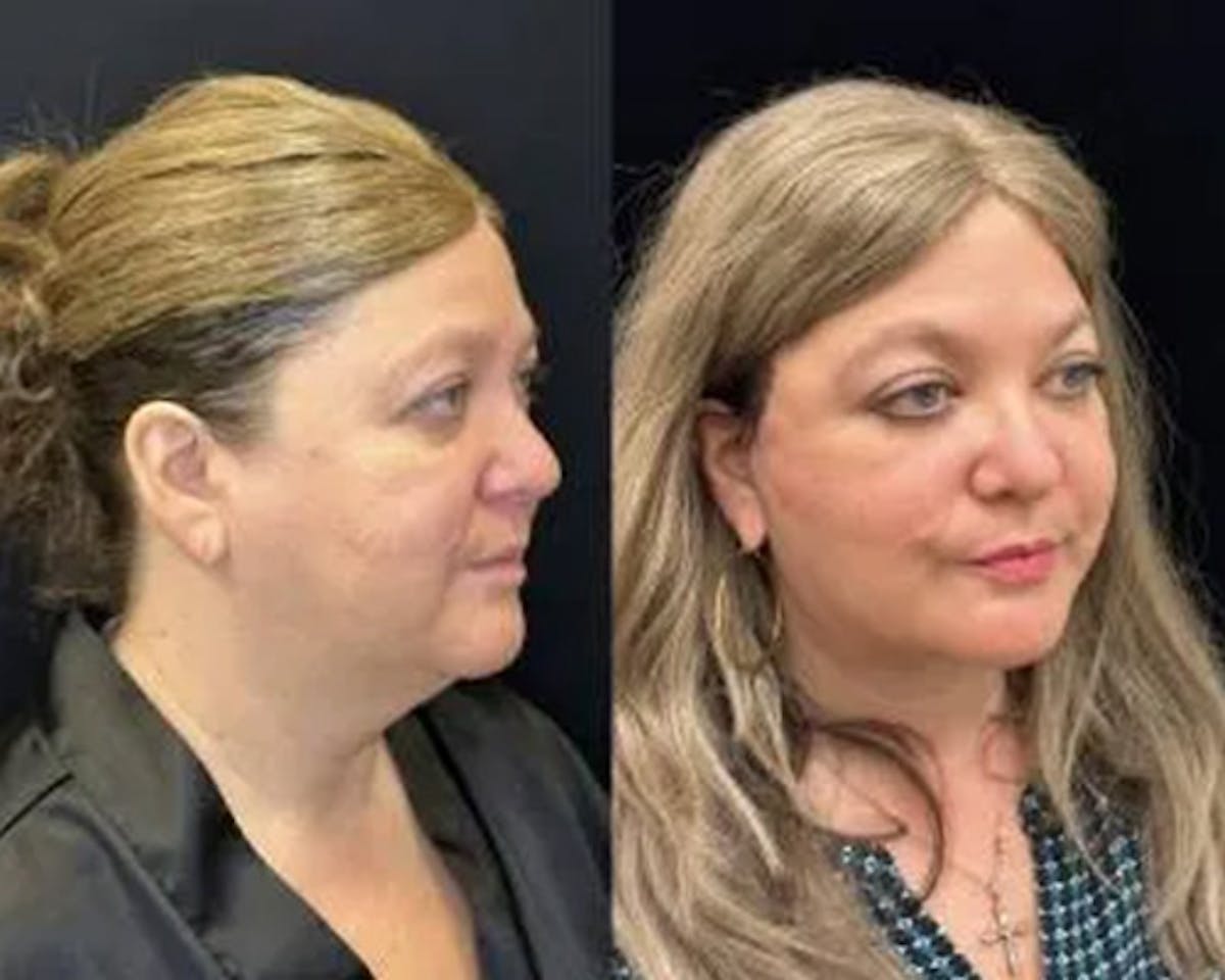 Deep Plane Facelift Before & After Gallery - Patient 202297 - Image 1