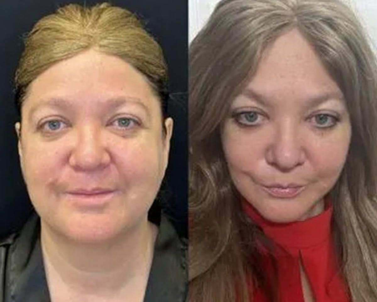Deep Plane Facelift Before & After Gallery - Patient 202297 - Image 2