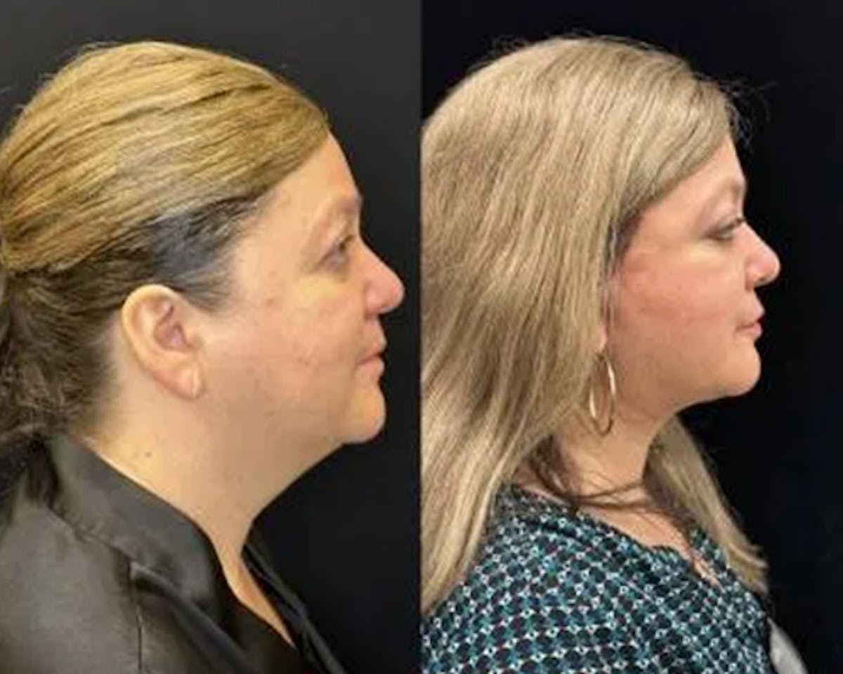 Deep Plane Facelift Before & After Gallery - Patient 202297 - Image 3