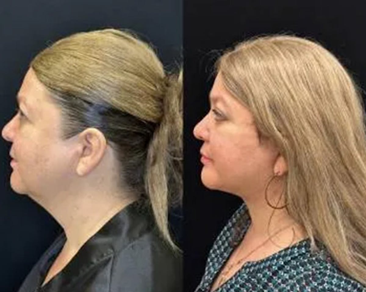 Deep Plane Facelift Before & After Gallery - Patient 202297 - Image 4