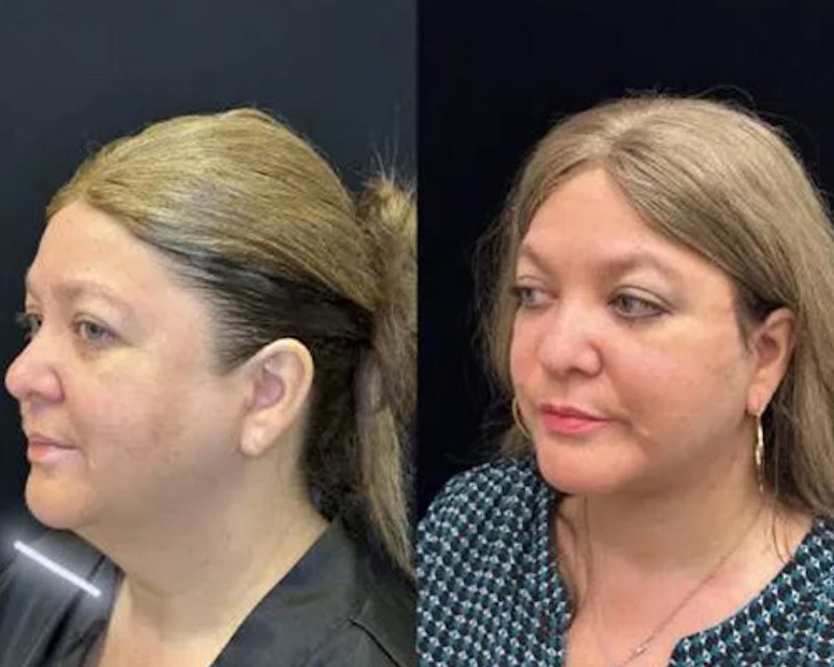 Deep Plane Facelift Before & After Gallery - Patient 202297 - Image 5