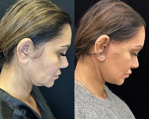 Deep Plane Facelift Before & After Gallery - Patient 373695 - Image 1