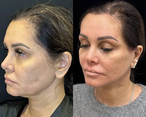 Deep Plane Facelift Before & After Gallery - Patient 373695 - Image 2