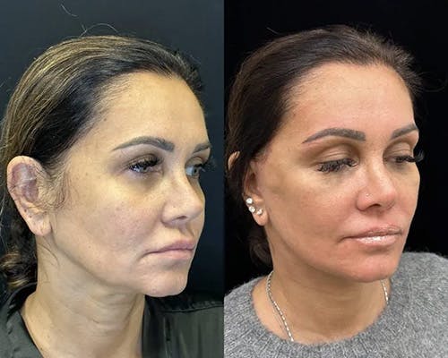 Deep Plane Facelift Before & After Gallery - Patient 373695 - Image 3