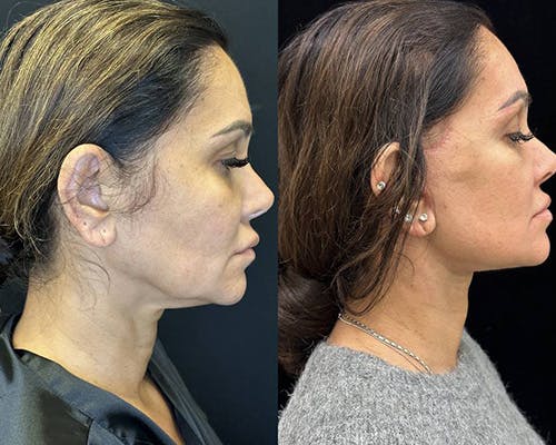 Deep Plane Facelift Before & After Gallery - Patient 373695 - Image 4