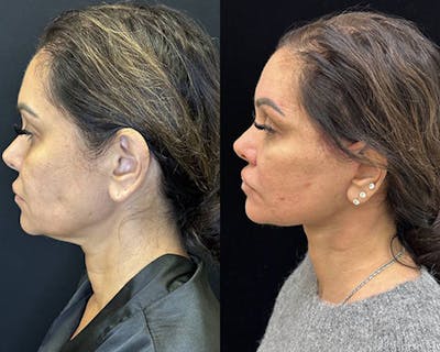 Deep Plane Facelift Before & After Gallery - Patient 373695 - Image 5