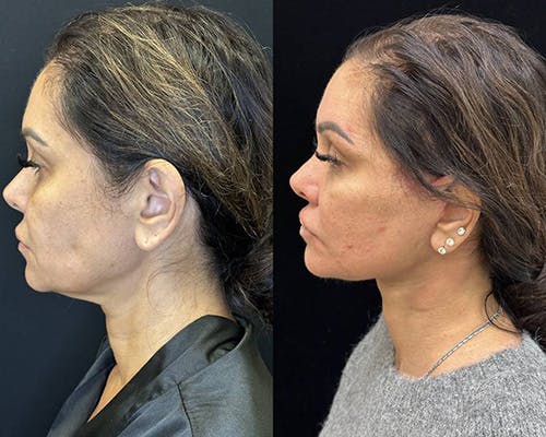 Deep Plane Facelift Before & After Gallery - Patient 373695 - Image 5