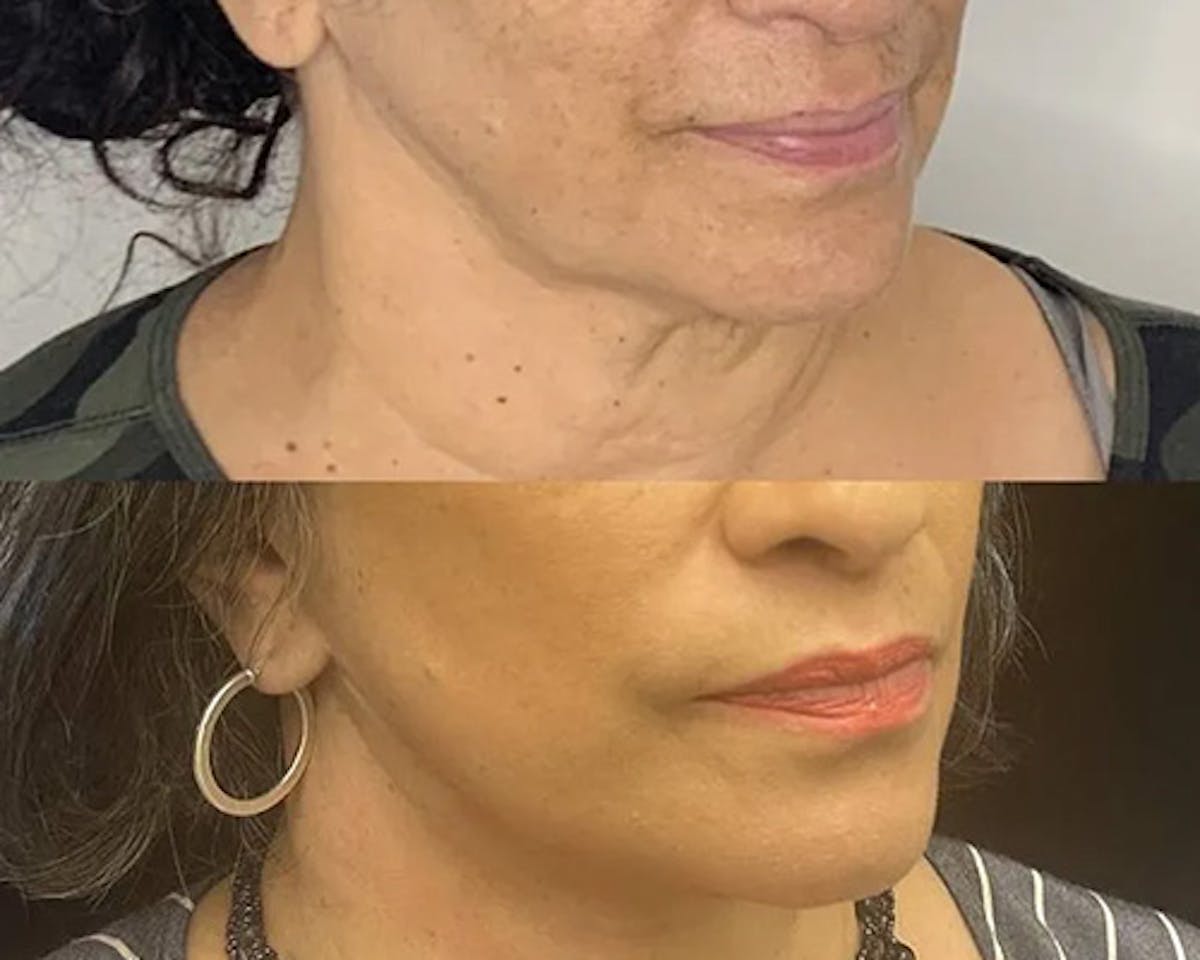 Deep Plane Facelift Before & After Gallery - Patient 948968 - Image 1