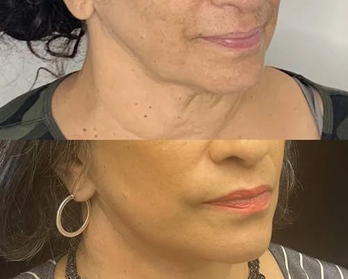 Deep Plane Facelift Before & After Gallery - Patient 948968 - Image 1