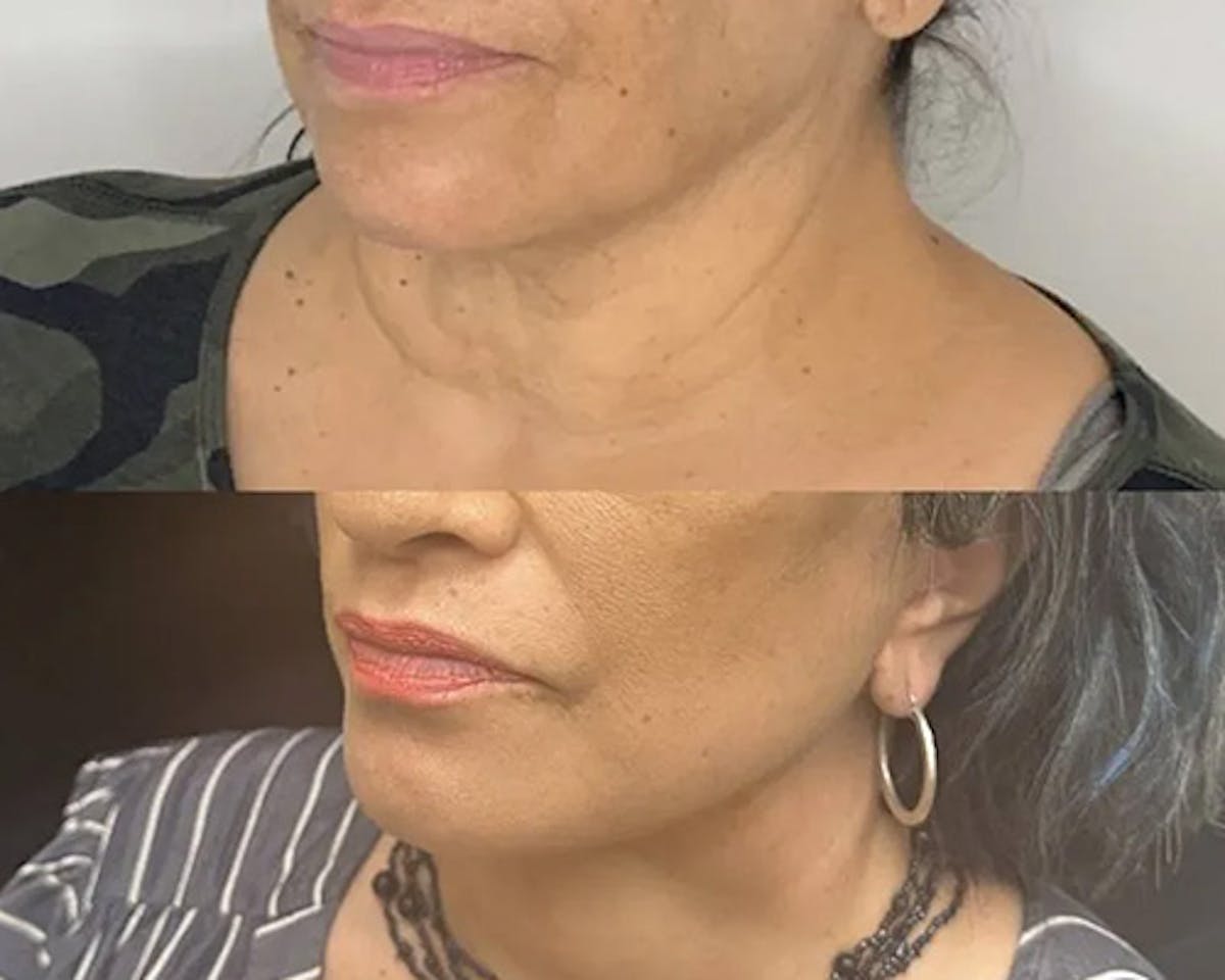 Deep Plane Facelift Before & After Gallery - Patient 948968 - Image 2