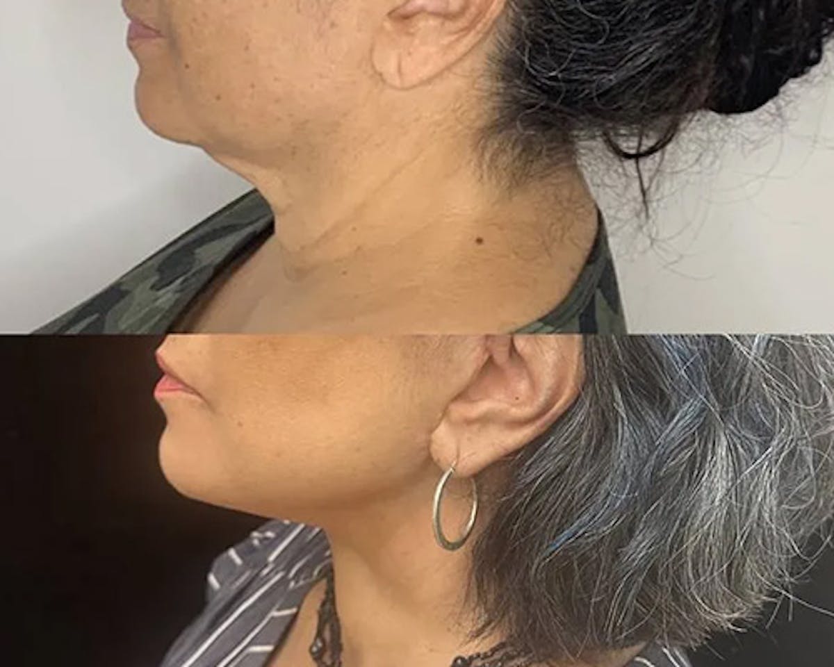 Deep Plane Facelift Before & After Gallery - Patient 948968 - Image 3