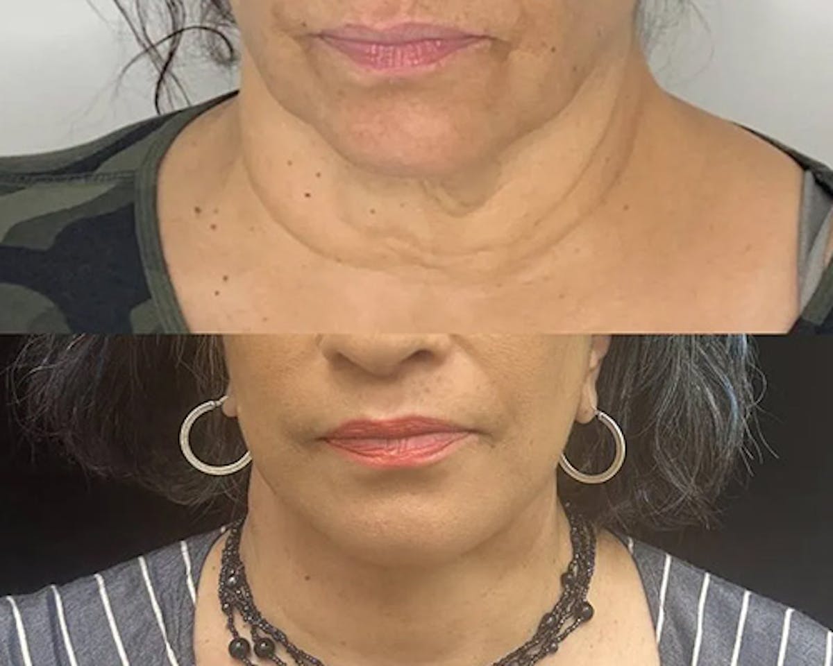 Deep Plane Facelift Before & After Gallery - Patient 948968 - Image 4