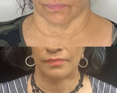 Deep Plane Facelift Before & After Gallery - Patient 948968 - Image 4