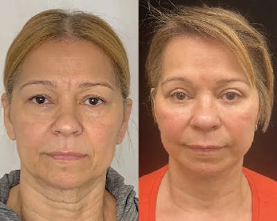 Deep Plane Facelift Before & After Gallery - Patient 423938 - Image 1