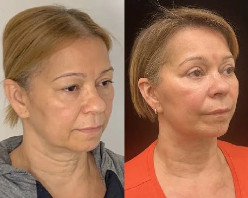 Deep Plane Facelift Before & After Gallery - Patient 423938 - Image 2