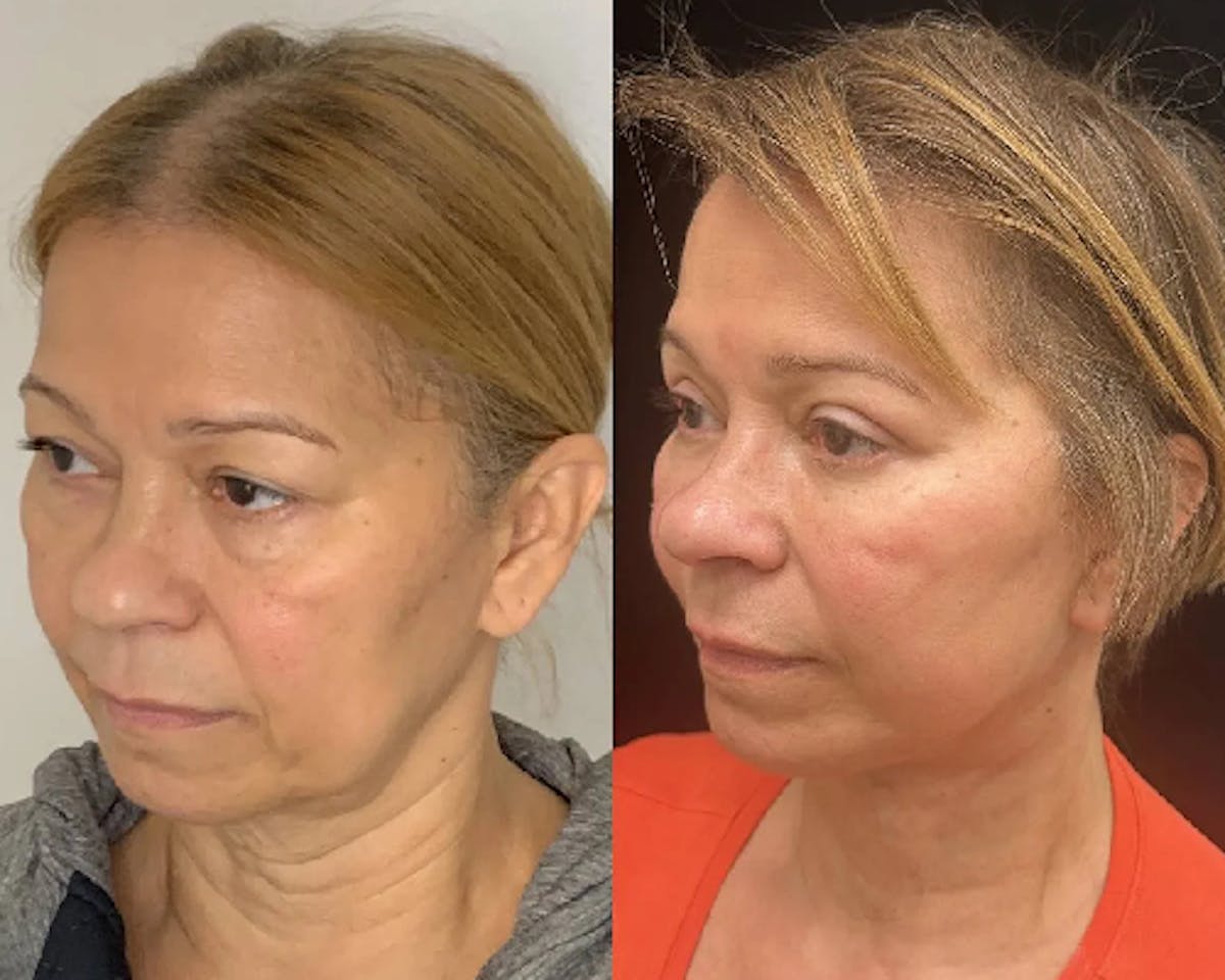 Deep Plane Facelift Before & After Gallery - Patient 423938 - Image 3