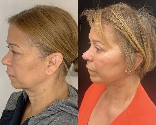 Deep Plane Facelift Before & After Gallery - Patient 423938 - Image 4