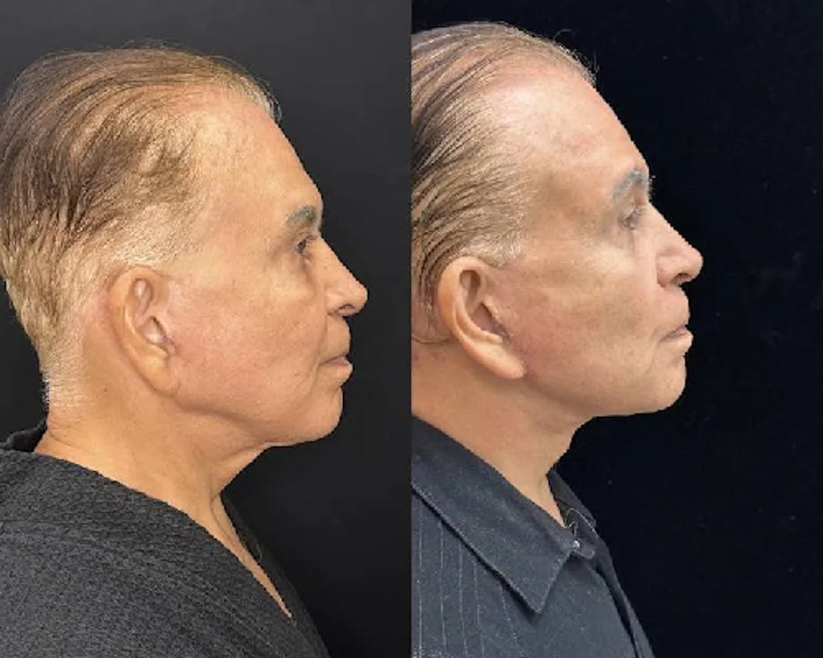 Male Facelift Before & After Gallery - Patient 369799 - Image 1