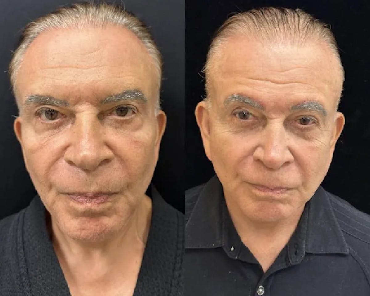 Male Facelift Before & After Gallery - Patient 369799 - Image 2