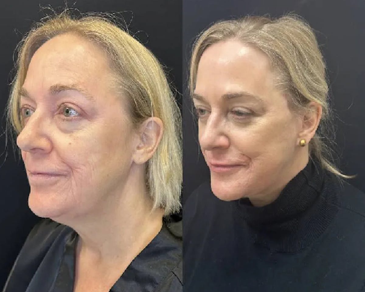 Deep Plane Facelift Before & After Gallery - Patient 145593 - Image 1