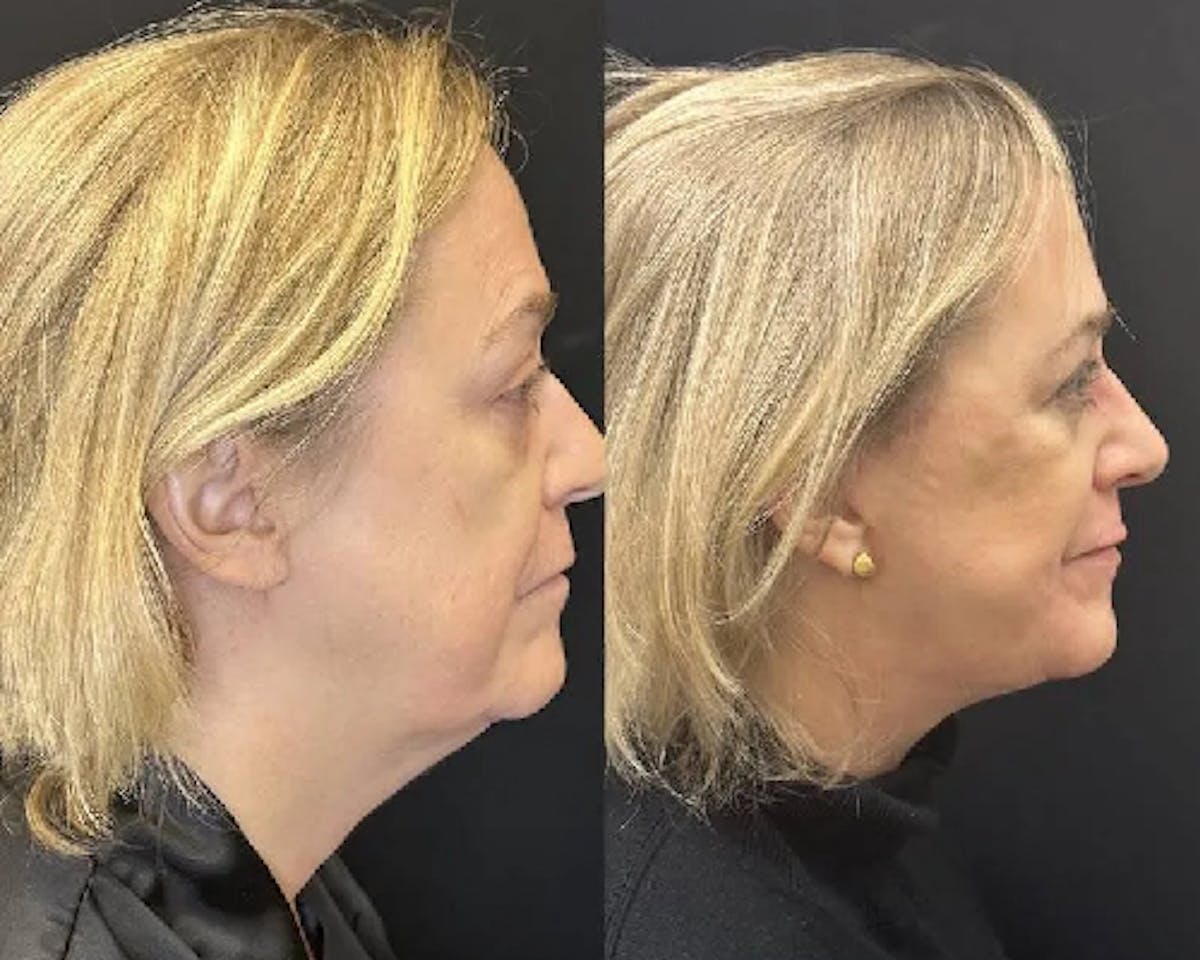 Deep Plane Facelift Before & After Gallery - Patient 145593 - Image 2
