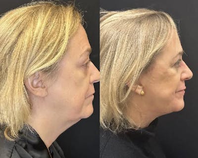 Deep Plane Facelift Before & After Gallery - Patient 145593 - Image 2