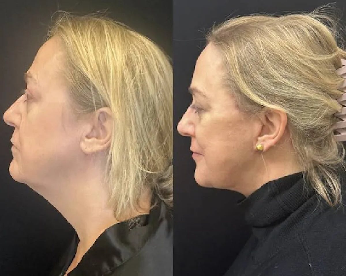 Deep Plane Facelift Before & After Gallery - Patient 145593 - Image 3