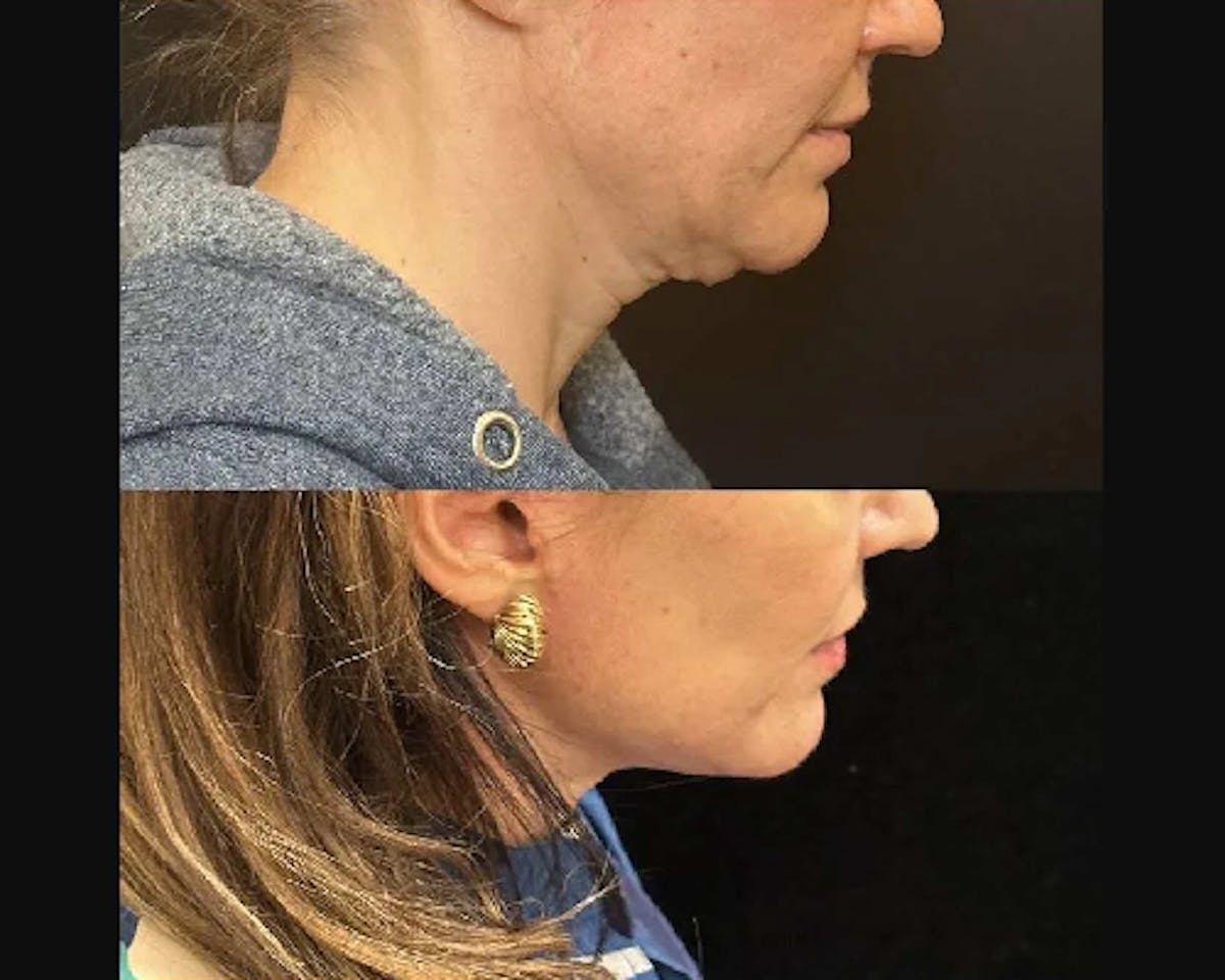Deep Plane Facelift Before & After Gallery - Patient 331731 - Image 1