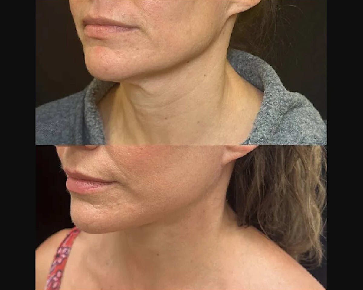 Deep Plane Facelift Before & After Gallery - Patient 331731 - Image 2