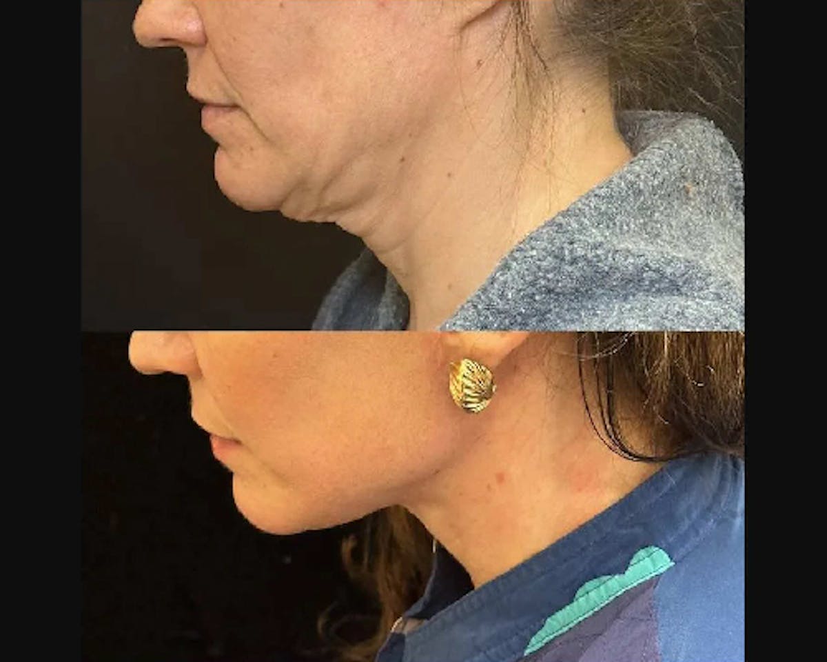 Deep Plane Facelift Before & After Gallery - Patient 331731 - Image 3