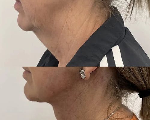 Deep Plane Facelift Before & After Gallery - Patient 257875 - Image 1