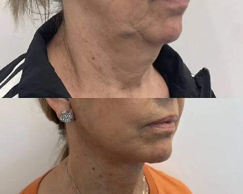 Deep Plane Facelift Before & After Gallery - Patient 257875 - Image 2