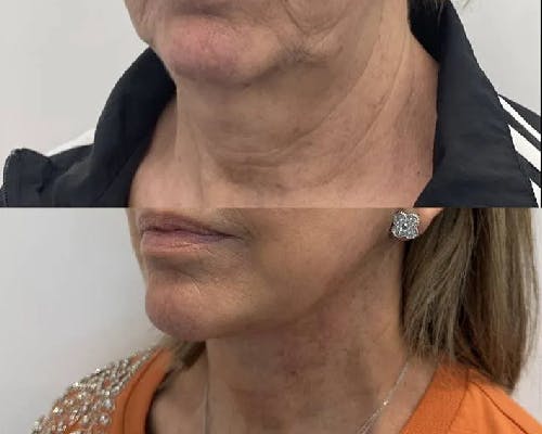 Deep Plane Facelift Before & After Gallery - Patient 257875 - Image 3