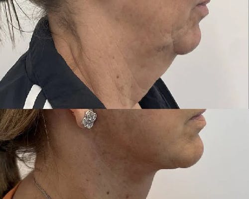 Deep Plane Facelift Before & After Gallery - Patient 257875 - Image 4