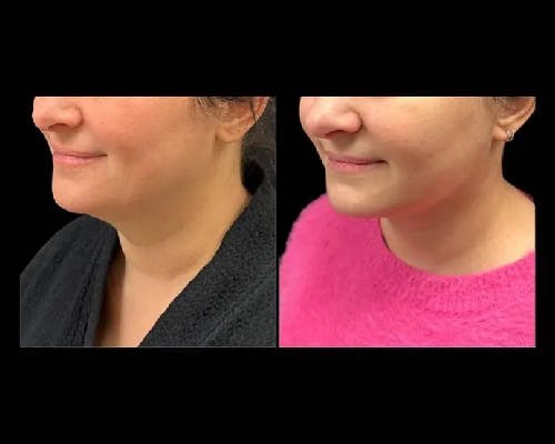 Deep Plane Facelift Before & After Gallery - Patient 149769 - Image 1