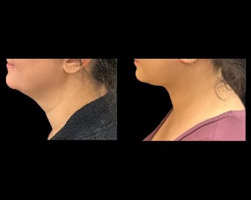 Deep Plane Facelift Before & After Gallery - Patient 149769 - Image 2