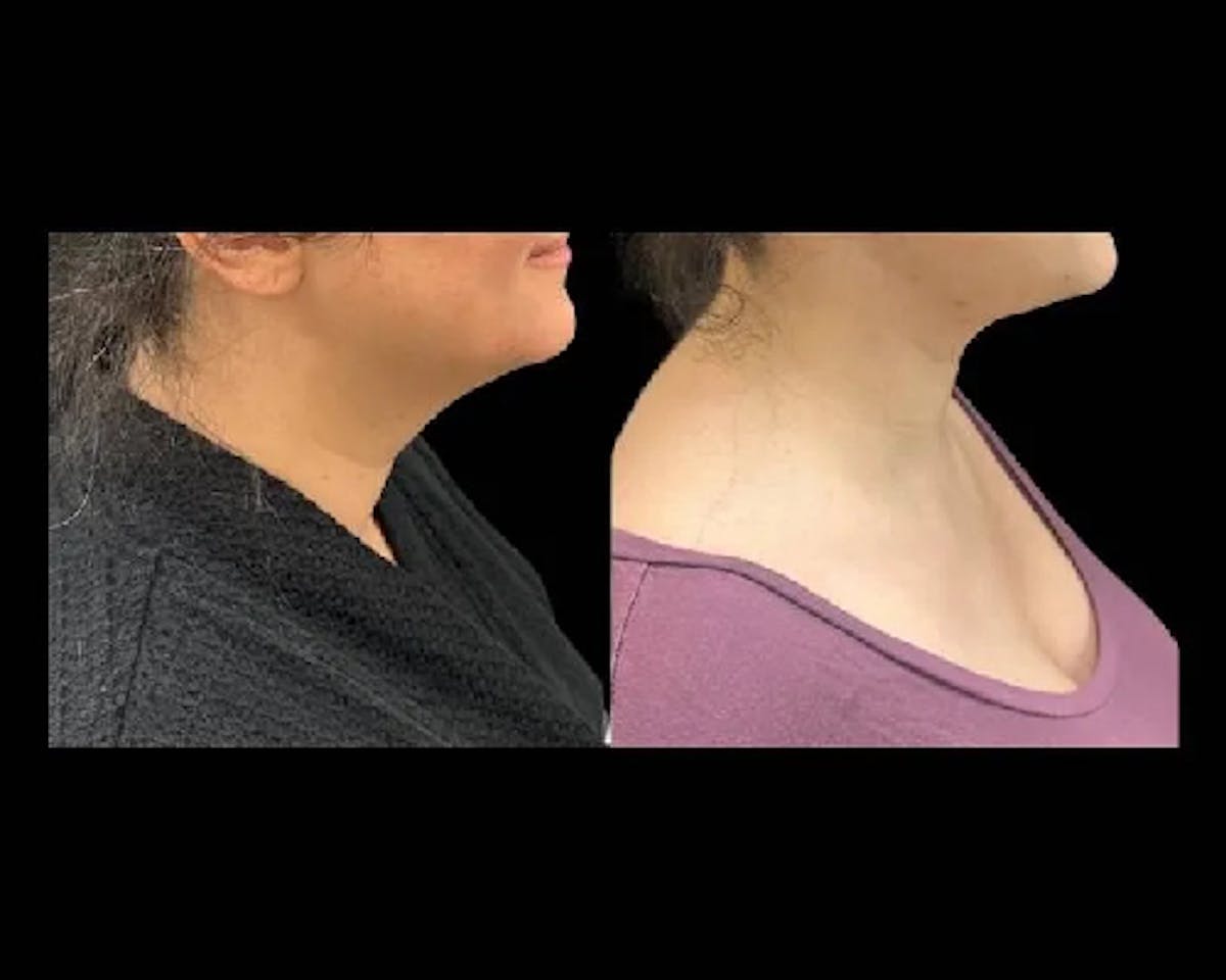 Deep Plane Facelift Before & After Gallery - Patient 149769 - Image 3