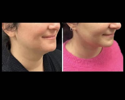 Deep Plane Facelift Before & After Gallery - Patient 149769 - Image 4