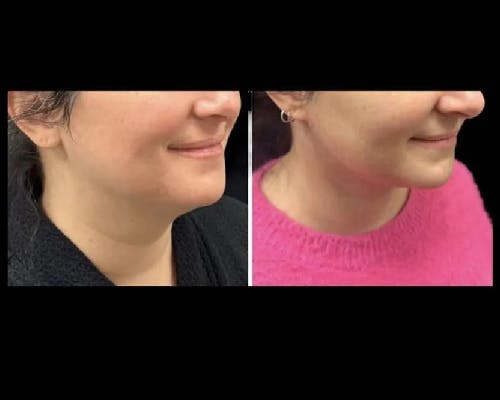 Deep Plane Facelift Before & After Gallery - Patient 149769 - Image 4
